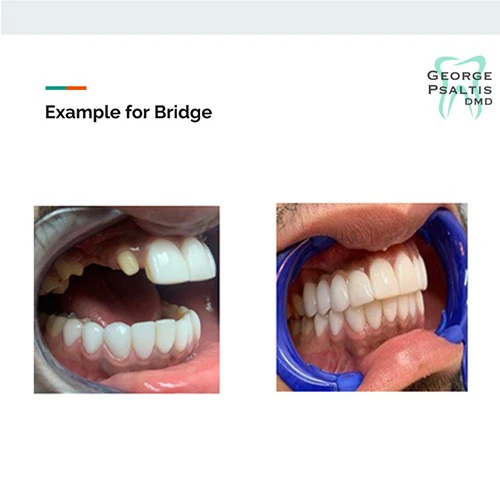 Before and after dental bridge