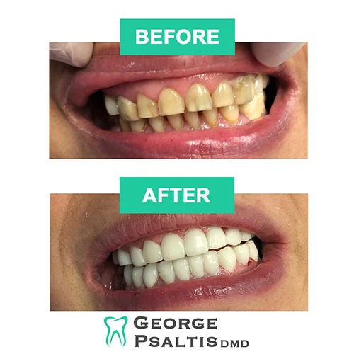 Before and after full mouth restoration