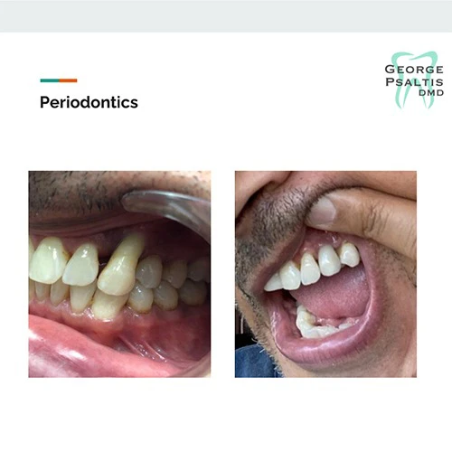 Before and after Periodontic treatment