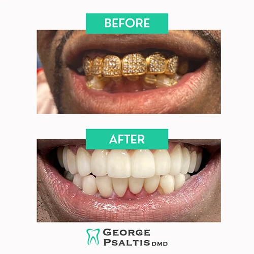 Before and after photos of a patient mouth restoration