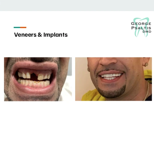Before and after photos of veneers and implants