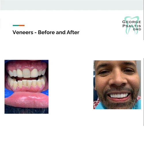Before and after photos of veneers