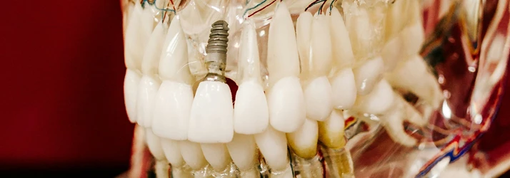 FC – Dental Implants at George Psaltis, DMD, PC in New York NY