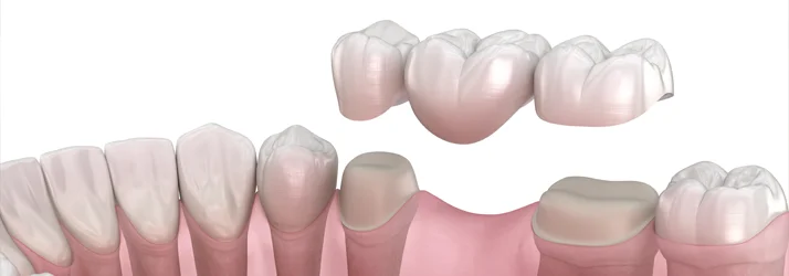 Dental Bridges in New York NY