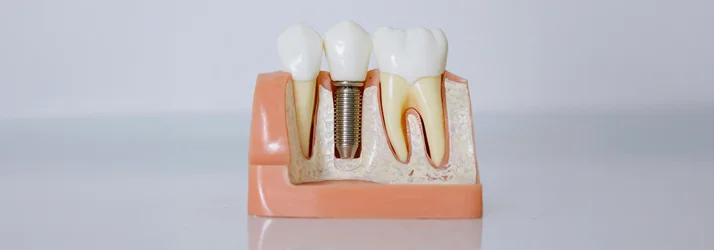 A model of a dental implant placed between two teeth