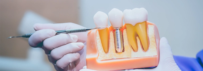 Dentist holding model to show a dental implant