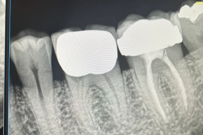FC – Root Canal Treatments & Emergency Dental Services at George Psaltis, DMD, PC in New York NY