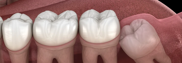 Digital image showing a wisdom tooth needing removal