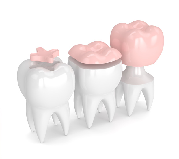 New York Dental Inlays and Onlays